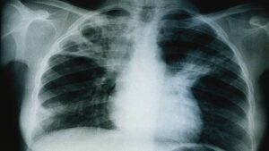 Togo-Santé : Le nombre de décès liés à la tuberculose réduit de 35%
