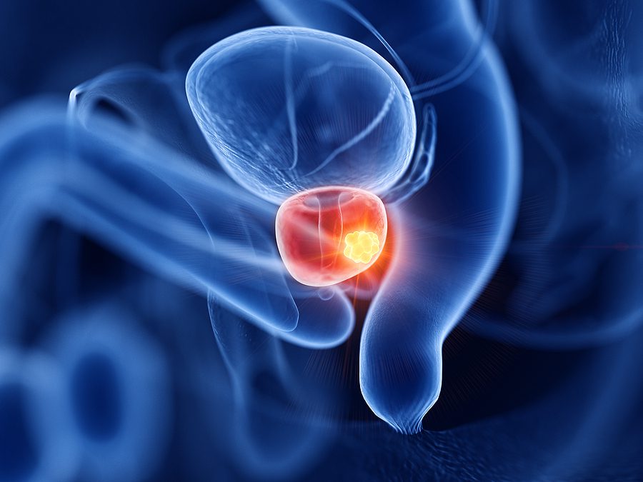 Prostate cancer