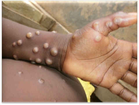 RDC monkeypox victime