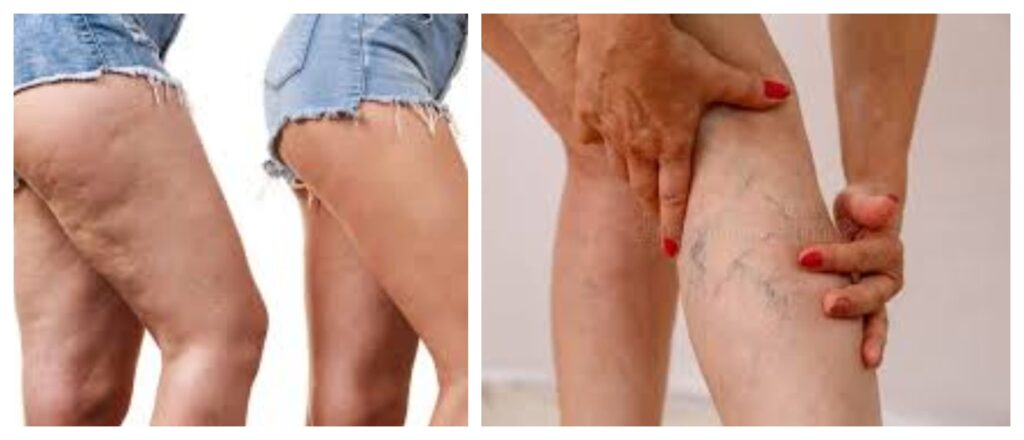 La cellulite : Tout ce que vous devez savoir et comment s'en débarrasser
