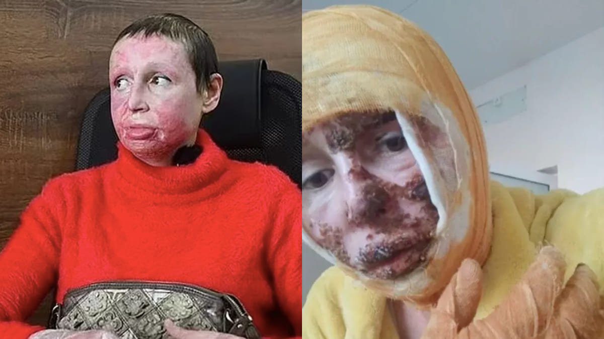Violences domestiques : Une femme crucifiée et brûlée par son ex-petit ami (PHOTOS)