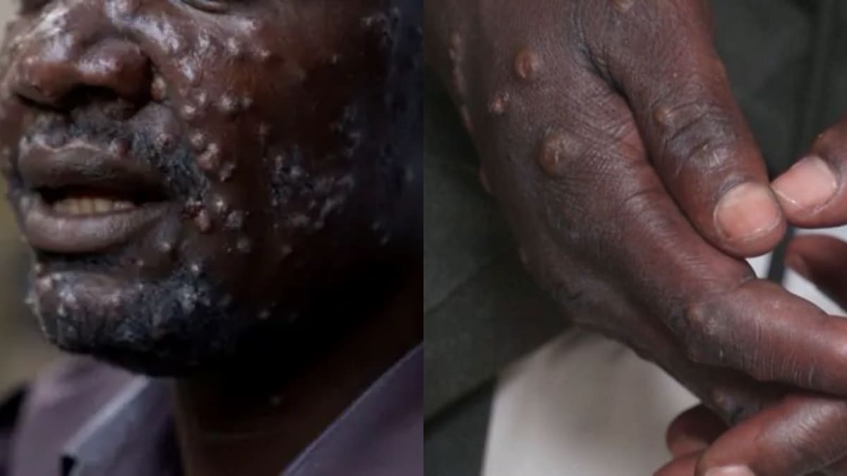 Variole du Singe : Le Togo en état d'alerte contre l'épidémie de Mpox