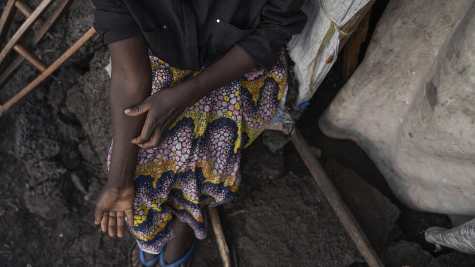 https://actulome.com/epidemie-de-mpox-le-gouvernement-guineen-prend-les-devants/