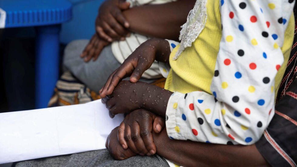 Epidémie du Mpox : Le Nigeria lance sa campagne de vaccination et dévoile ses ambitions