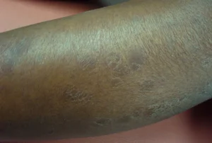 Maladies de la peau : Le Togo lance un projet de 350 millions FCFA pour intensifier la lutte