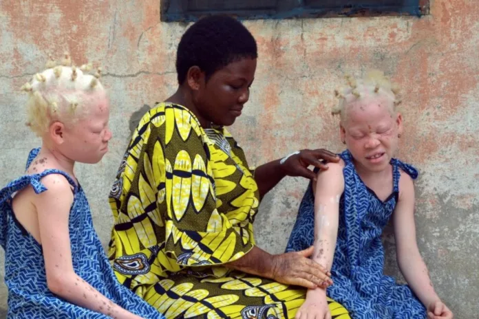 Congo-Brazzaville : Bonne nouvelle pour les albinos ! Bientôt...