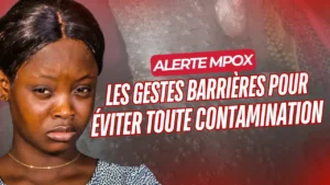 Alerte Premier cas de variole du singe (Mpox) confirmé au Togo : Voici les gestes barrières - Revue du 19 mai 2025
