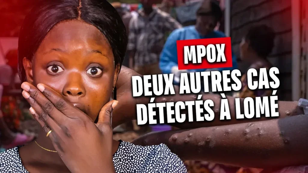 Deux autres cas de Mpox à Lomé, les autorités sanitaires se mobilisent - Revue du 23 mai 2025