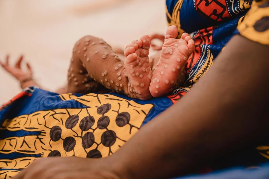 Mpox au Ghana : premier décès confirmé, l’État lance l’alerte