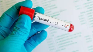 Togo : une épidémie de fièvre typhoïde confirmée dans le village de Pamini