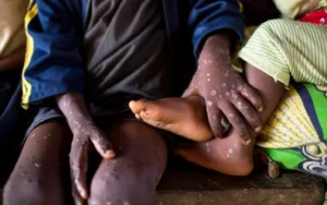 Alerte sanitaire au Ghana : 21 nouveaux cas de mpox confirmés
