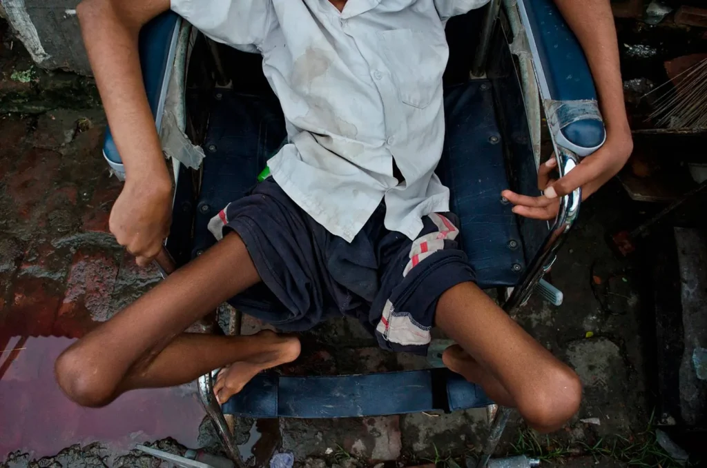 Togo : un cas de poliomyélite détecté dans la région Centrale