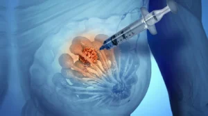 Succion des seins pour prévenir le cancer : une médecin répond vraiment
